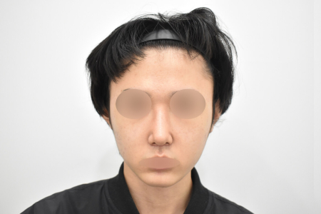 After — RESPECT Plastic Surgery