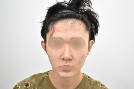 Before — RESPECT Plastic Surgery