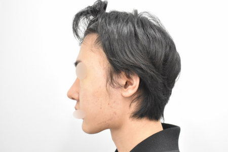 After — RESPECT Plastic Surgery