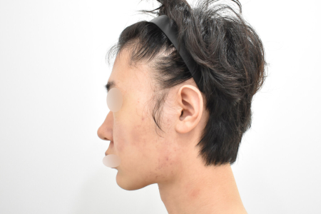 Before — RESPECT Plastic Surgery