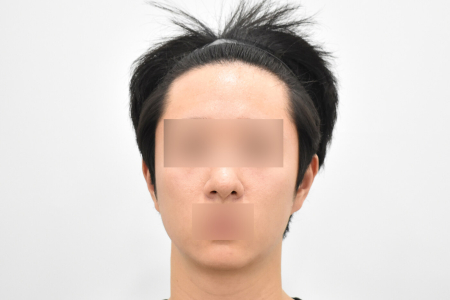 After — RESPECT Plastic Surgery