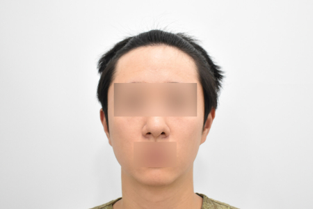Before — RESPECT Plastic Surgery