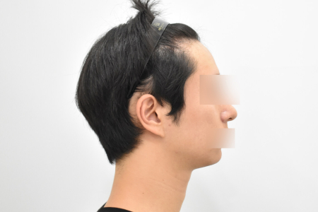 After — RESPECT Plastic Surgery