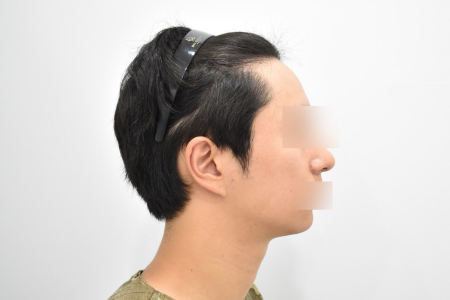 Before — RESPECT Plastic Surgery