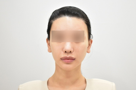 After — RESPECT Plastic Surgery