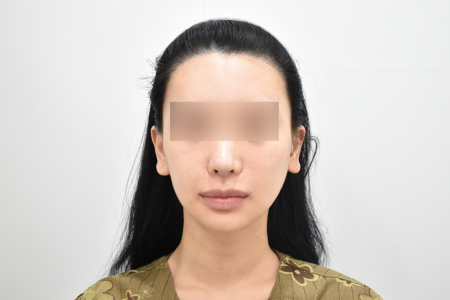 Before — RESPECT Plastic Surgery