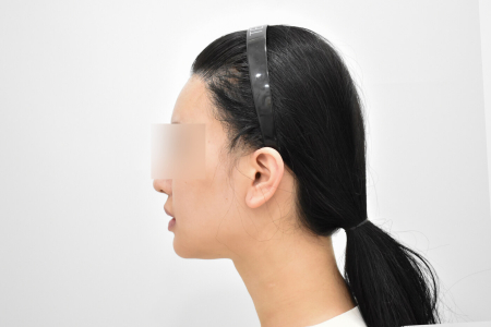 After — RESPECT Plastic Surgery