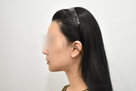 Before — RESPECT Plastic Surgery
