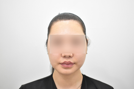 After — RESPECT Plastic Surgery