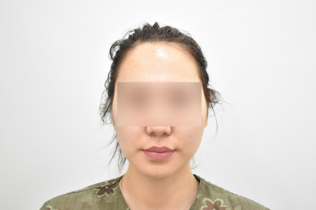 Before — RESPECT Plastic Surgery