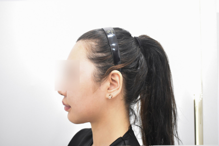 After — RESPECT Plastic Surgery