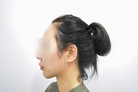 Before — RESPECT Plastic Surgery