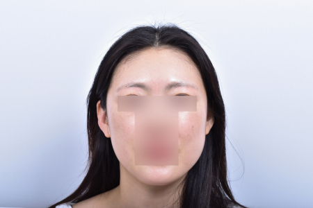 After — RESPECT Plastic Surgery