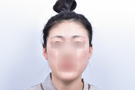 Before — RESPECT Plastic Surgery