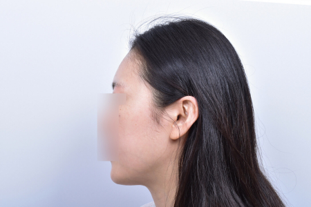 After — RESPECT Plastic Surgery