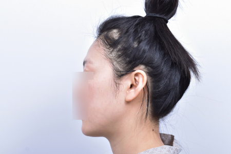 Before — RESPECT Plastic Surgery