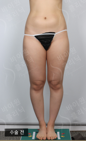 Before — BYWON Clinic