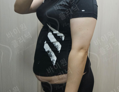 Before — BYWON Clinic