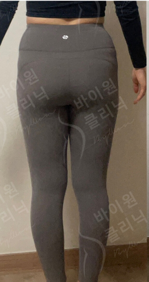 Before — BYWON Clinic