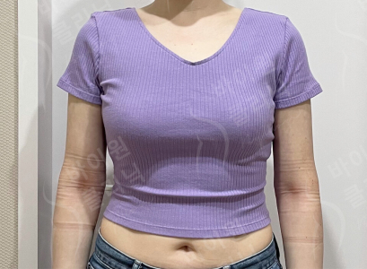 After — BYWON Clinic