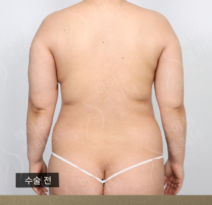 Before — BYWON Clinic