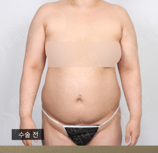 Before — BYWON Clinic