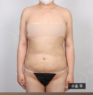 After — BYWON Clinic