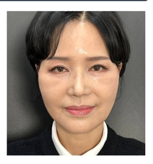 After — Returning Plastic Surgery