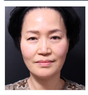 Before — Returning Plastic Surgery