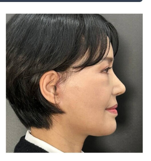 After — Returning Plastic Surgery