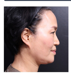 Before — Returning Plastic Surgery