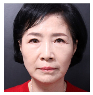 After — Returning Plastic Surgery
