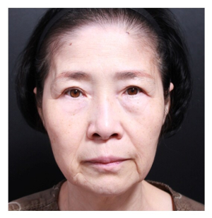 Before — Returning Plastic Surgery