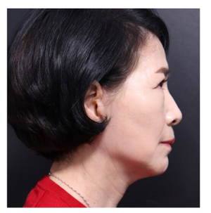 After — Returning Plastic Surgery