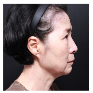 Before — Returning Plastic Surgery