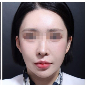 After — Returning Plastic Surgery