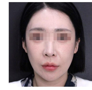 Before — Returning Plastic Surgery
