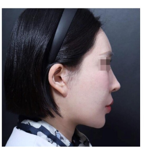 After — Returning Plastic Surgery