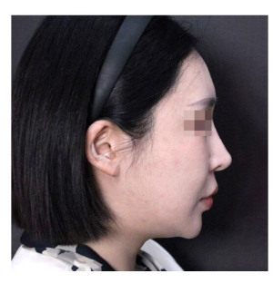 Before — Returning Plastic Surgery