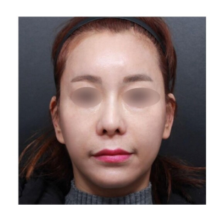 After — Returning Plastic Surgery