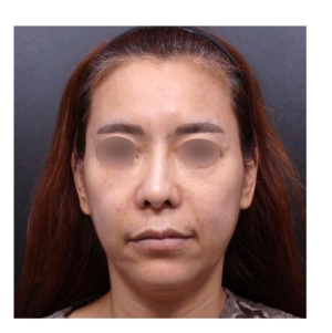 Before — Returning Plastic Surgery
