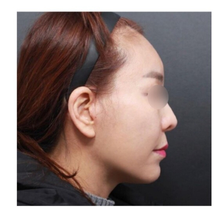 After — Returning Plastic Surgery