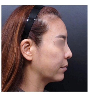 Before — Returning Plastic Surgery