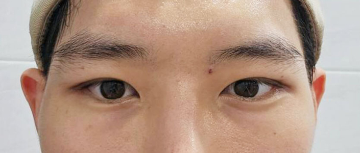 After — Returning Plastic Surgery
