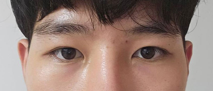 Before — Returning Plastic Surgery