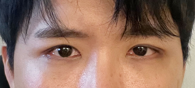After — Returning Plastic Surgery