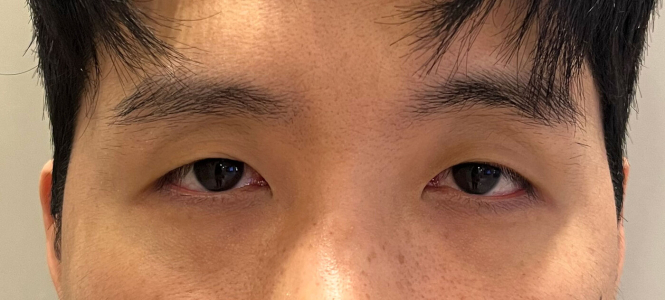 Before — Returning Plastic Surgery