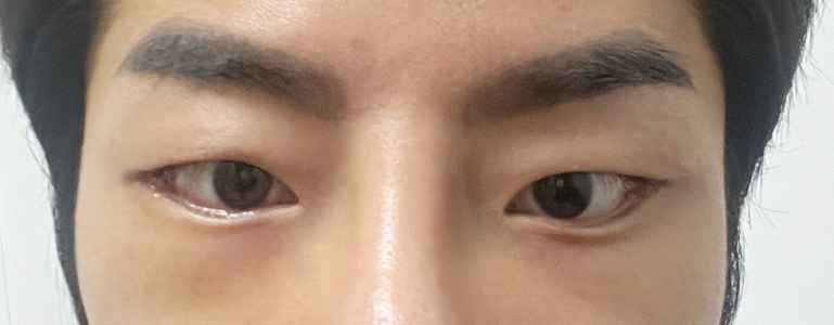 After — Returning Plastic Surgery