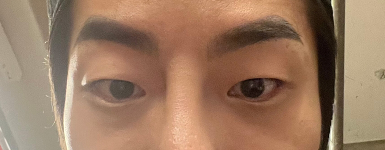 Before — Returning Plastic Surgery