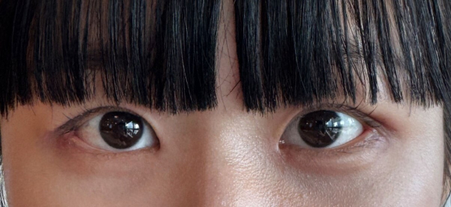 After — Returning Plastic Surgery